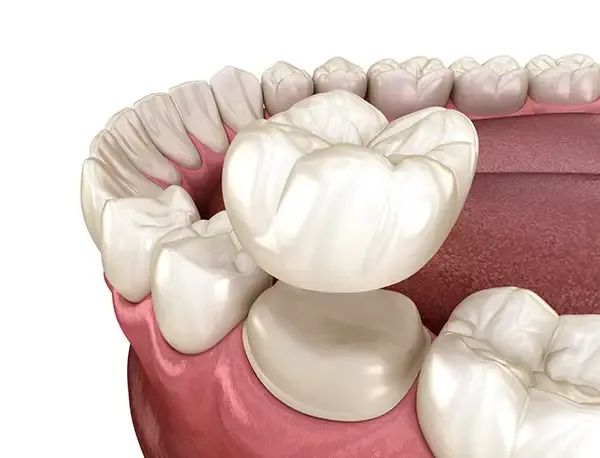 A dental crown being placed on a prepared tooth in the upper jaw, illustrating the restoration process.