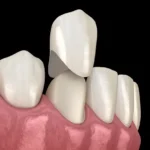 A dental crown being placed on a front tooth, highlighting the precise fit and restoration process.