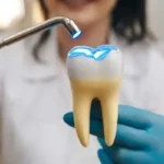 A dental model being treated with a curing light to illustrate the process of setting a filling material during restorative dental care.