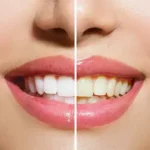 Whitened smile after professional teeth whitening at Dalrock Dental Care in Rowlett, TX