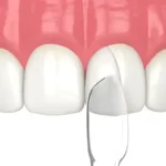 A close-up of the dental bonding procedure showing a composite resin layer being applied to a tooth.
