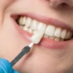 Dentist using a precise shade matching tool to select the ideal dental veneer for a smiling patient’s teeth.
