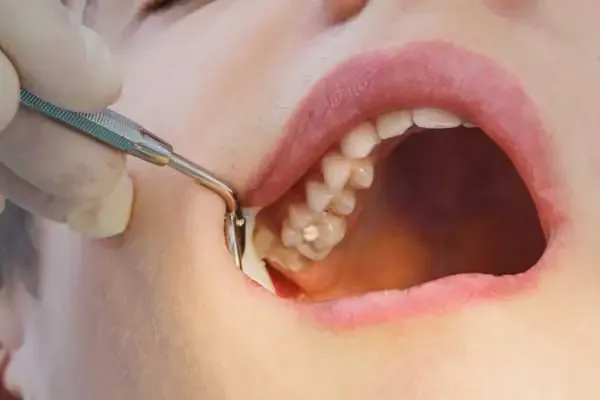 A dentist examining a patient’s tooth cavity with a dental instrument before placing a filling, demonstrating the cavity treatment process.
