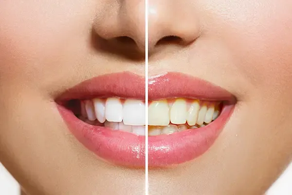 Whitened smile after professional teeth whitening at Dalrock Dental Care in Rowlett, TX