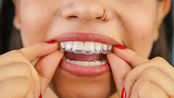 Read more about the article 5 Reasons Why Rowlett Families Are Choosing Invisalign Over Braces​